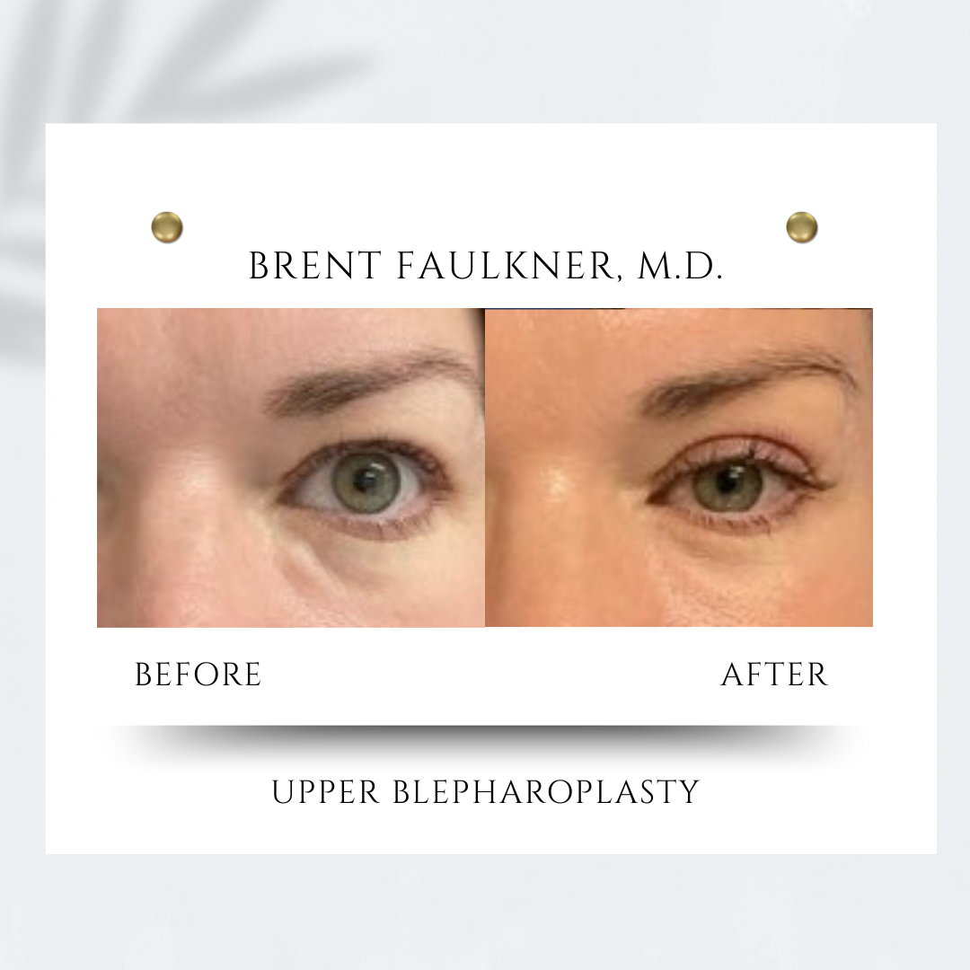 The before-and-after photos show the results of a patient's upper bleph near Rockville.