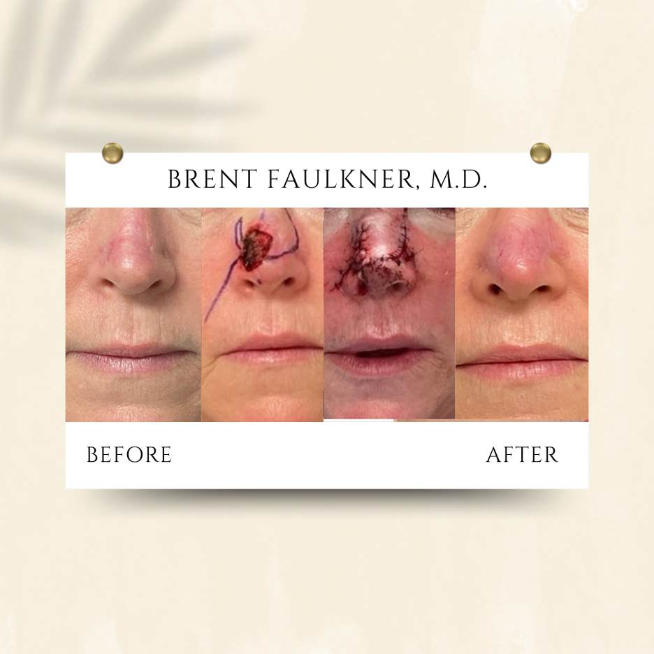 The collage displays before-and-after shots of a patient who opted for MOHS reconstruction following basal cell skin cancer surgery near Bethesda, MD.
